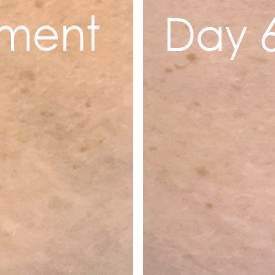 before and after reducing the appearance of stretch marks