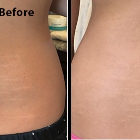 before and after - reduce the appearance of stretch marks with ReTone
