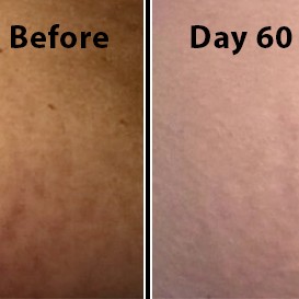 before and after - reduce the appearance of stretch marks with ReTone