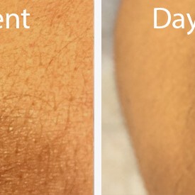 before and after - reduce the appearance of scars