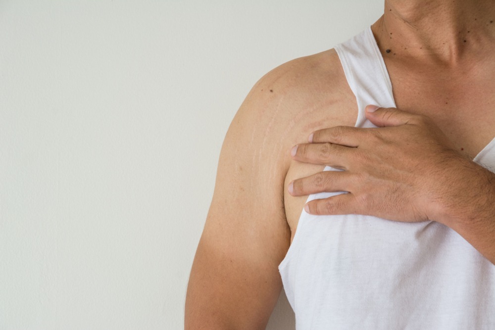 stretch marks on male arm